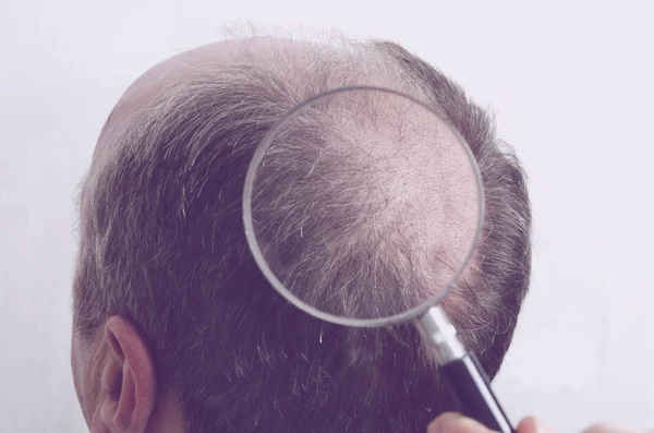 Soluciones para el cabello fino en hombres: Guía completa para un cabello fuerte y voluminoso 4 Lupa enfocando cabello fino y calvicie